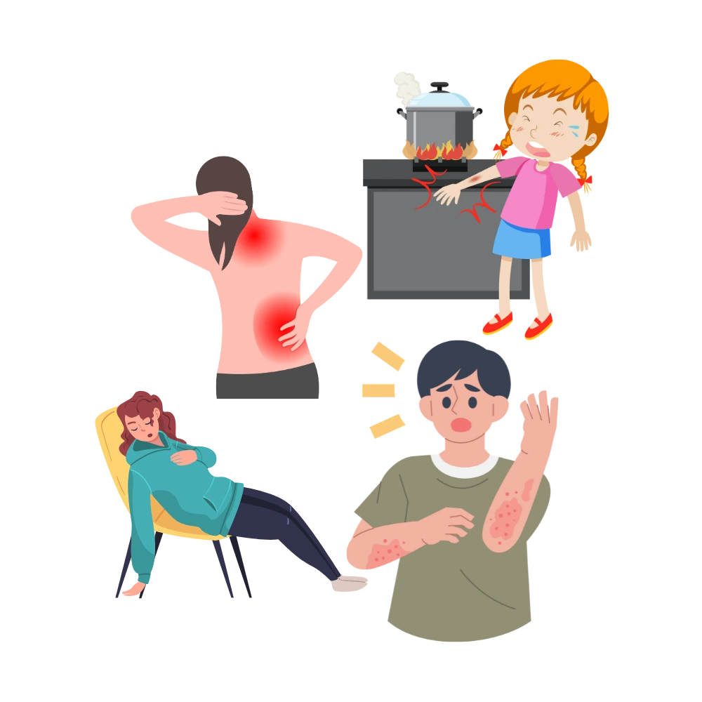 Burns, Insect bites, common allergies